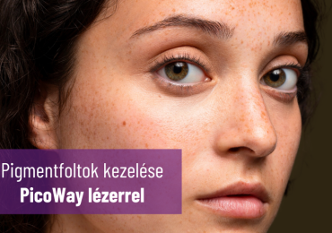 Pigmentfoltok halványítása Picoway lézerrel